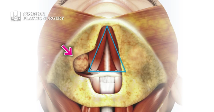 After the deep fat (blue triangle) is removed, bulging may be visible on both sides.
