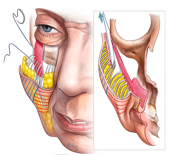 SMAS facelift