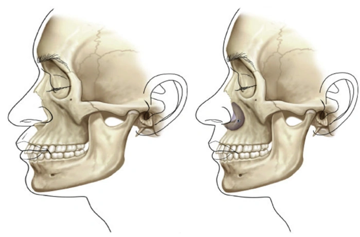 (左图）展示了中面部骨骼的凹陷形态，(右图）则说明了可以通过植入物进行中面部填充
