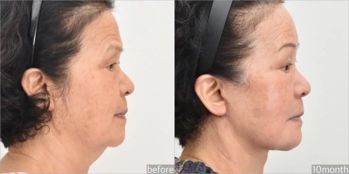 Natural earlobes and preserved auricular cartilage after facelift