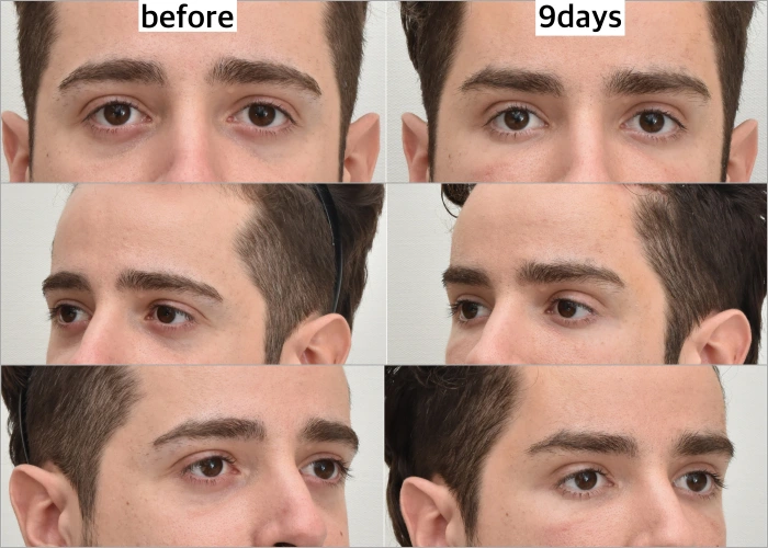 Early Post-Op of Fox Eye Lift at Korean Plastic Surgery Clinic