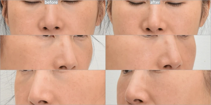 薄皮导致黑眼圈，经纳米脂肪移植改善