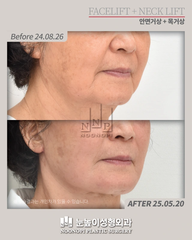 نتائج شد الوجه في Noonopi Plastic Surgery Korea