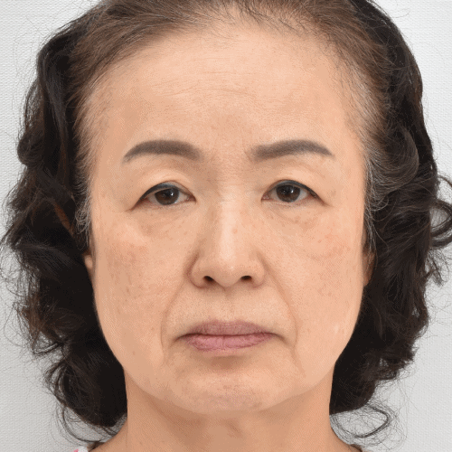 除皱术前后对比 (3个月)