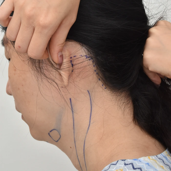 全颈部提升术中，耳后切口可有效改善皮肤松弛问题