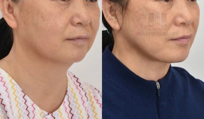 位60多岁患者“面部提升”与“颈部提升”联合手术的术前术后对比照,面部显著年轻化。