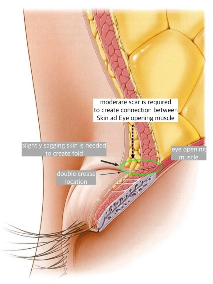 双眼皮手术原理:需通过瘢痕连接形成褶皱