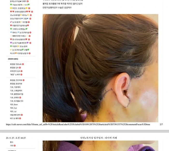 未知医生操作的面部提升术自拍