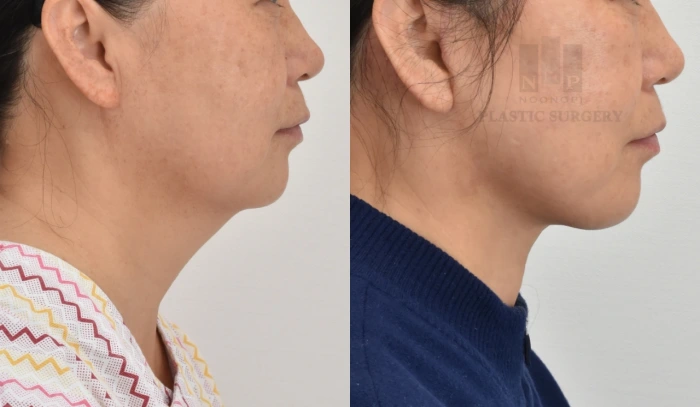 نتيجة شد الوجه والرقبة لمريضة تبلغ 60 عامًا، تُظهر تحسين ترهلات الوجه وخط الفك.