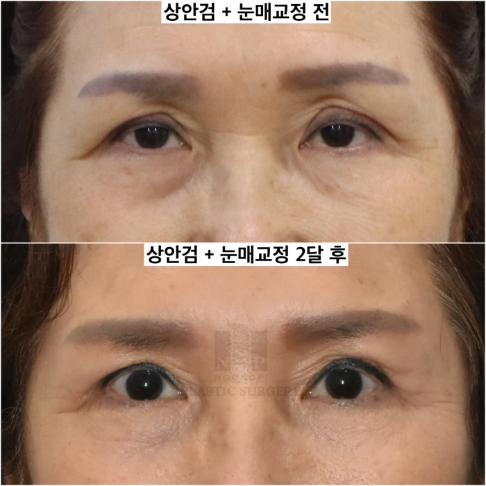 تصحيح جراحة تجميل الجفون في كوريا