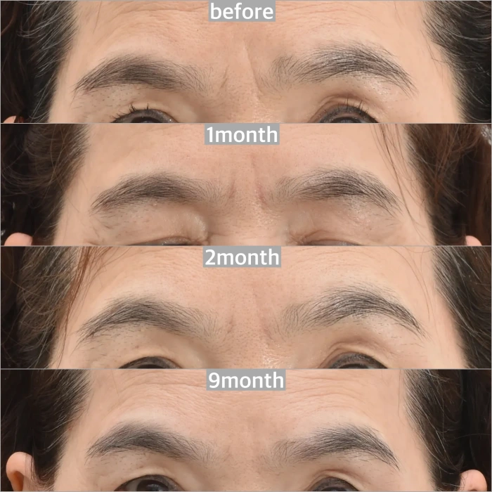 الخط الزمني بعد إزالة التجاعيد بين الحاجبين بالليزر في Noonopi