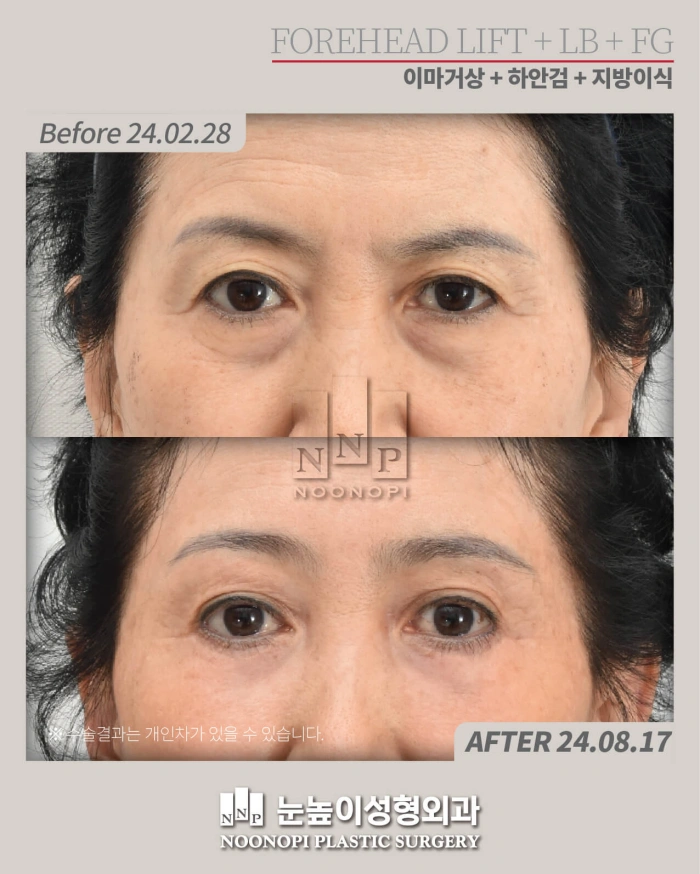 عملية تجميل الجفن السفلي قبل وبعد في سن الستينيات