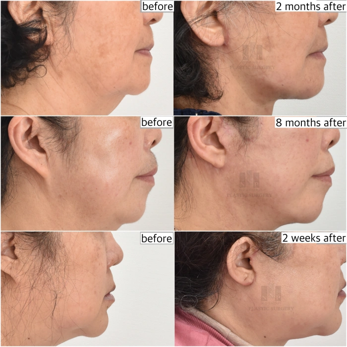 Korean facelift scars before after