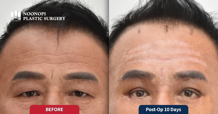 상하안검, 눈썹 거상, 프락셔널 레이저를 병행하여 완성된 매끈한 이마 사진