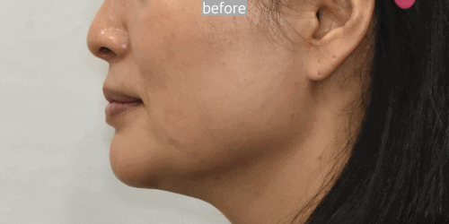 deep plane facelift korea