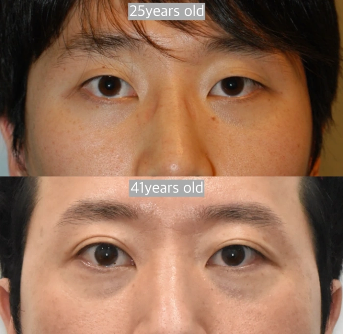 طيات طبيعية مع التقدم في العمر