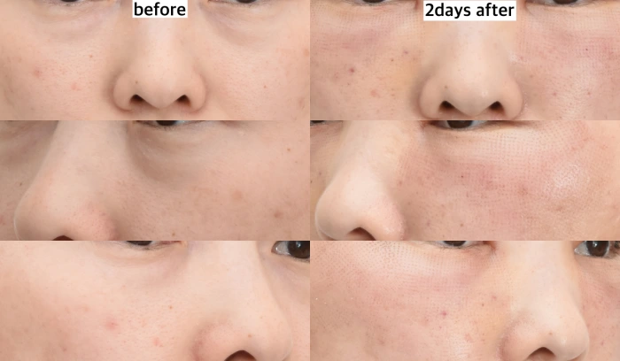 激光眼睑紧致与脂肪重置术后2天