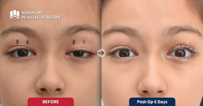 先天性眼睑下垂术后恢复及最终对称效果