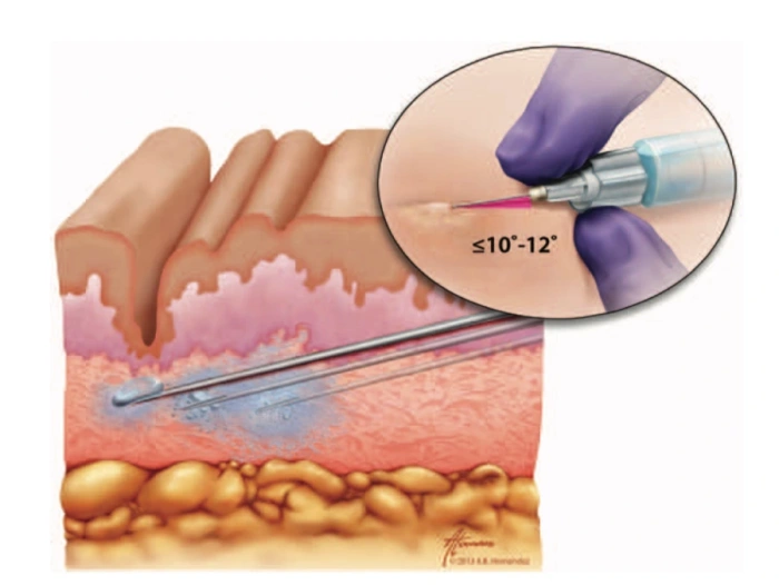 Dermal filler injections