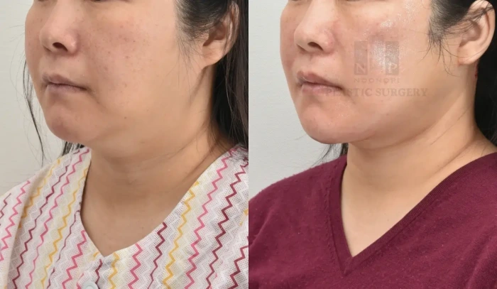 عملية شد الوجه والرقبة معًا في سن الثلاثينيات