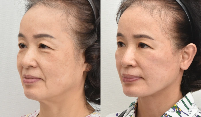 안면거상술 전후