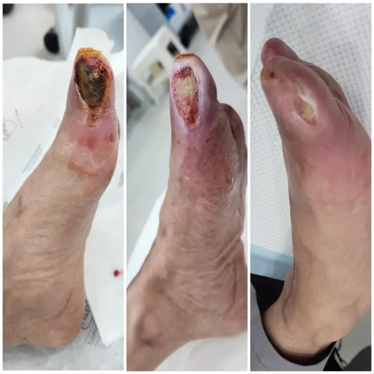 高压氧促进糖尿病足溃疡愈合