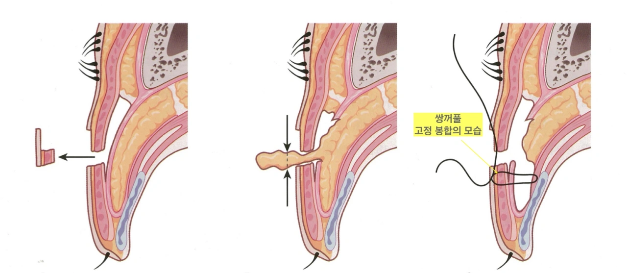 double eyelid surgery procedure