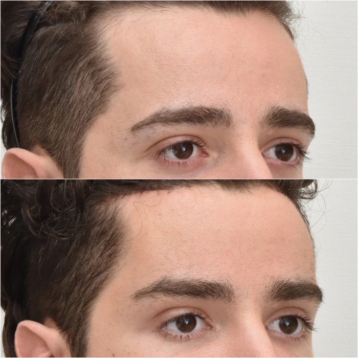 korea temporal brow lift