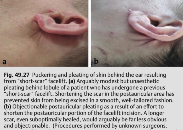 مضاعفات عمليات شد الوجه المصغرة (من فن الجراحة التجميلية: المبادئ والتقنيات)