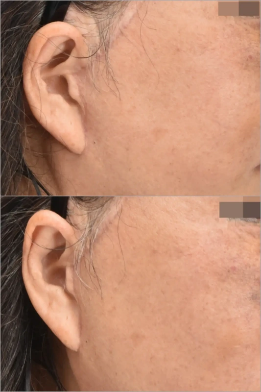 pixie ear deformity after poor facelift