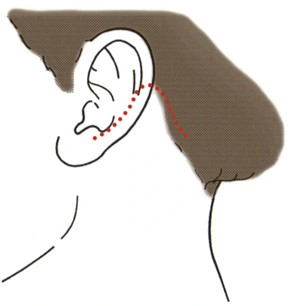 Along the hairline incision in facelift