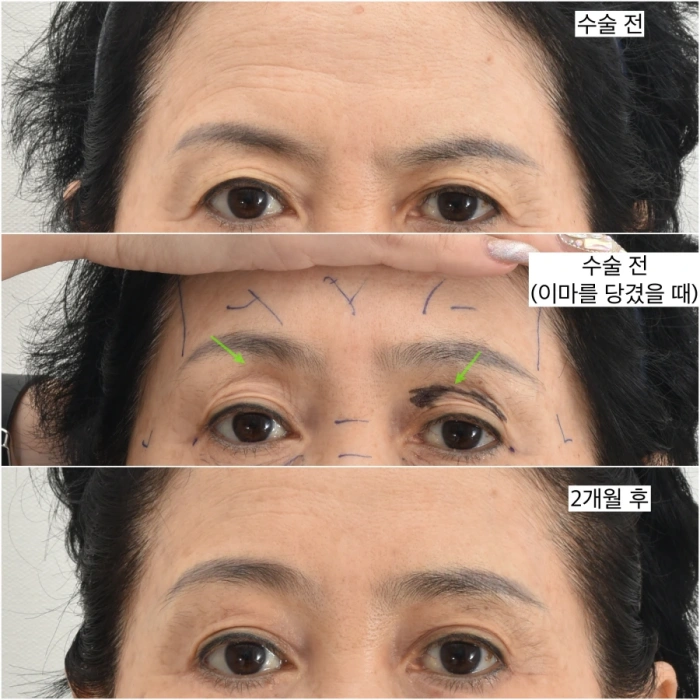 fat graft combined with forehead lift