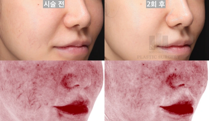 Telangiectasia (broken capillaries) treatment