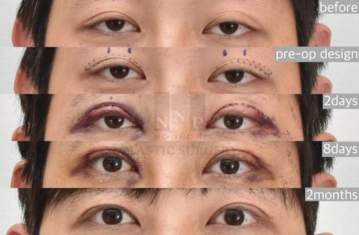 双眼皮+眼睑下垂手术恢复周期
