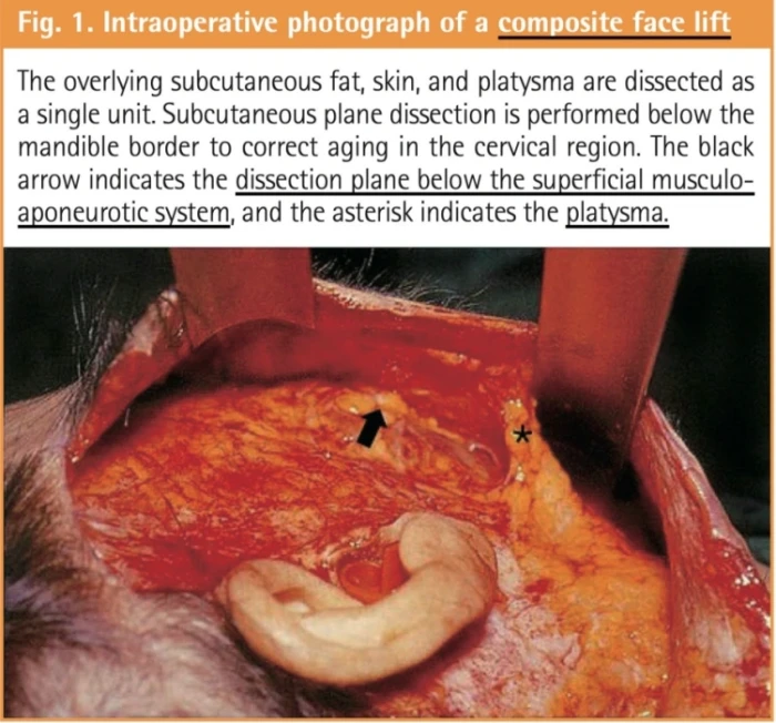 منظر أثناء عملية شد الوجه المركب (من و
