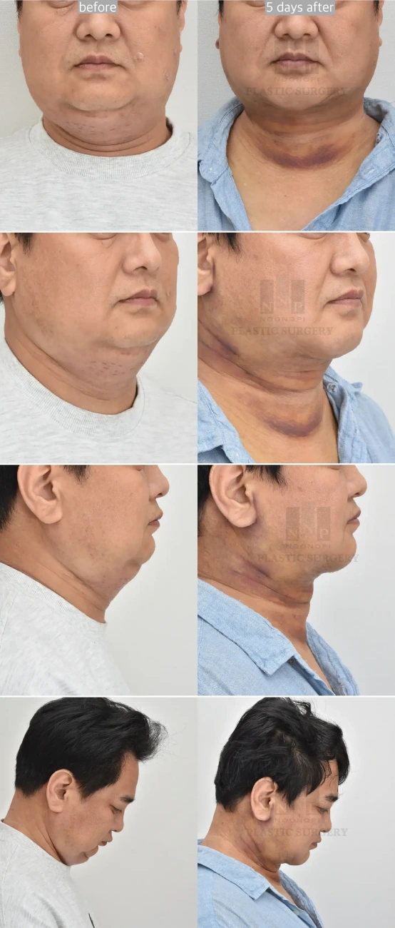 neck contour change after neck lift in 5 days